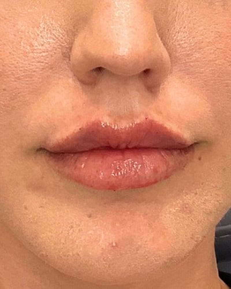 Dermal Fillers Before & After Gallery - Patient 254723 - Image 2