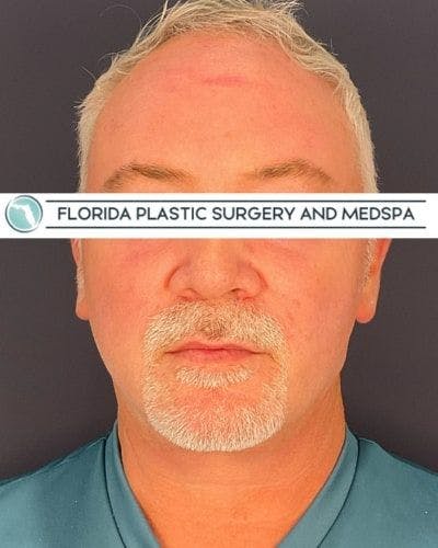 Dermal Fillers Before & After Gallery - Patient 386850 - Image 1