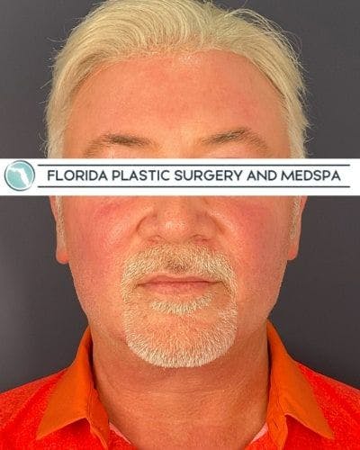 Dermal Fillers Before & After Gallery - Patient 386850 - Image 2