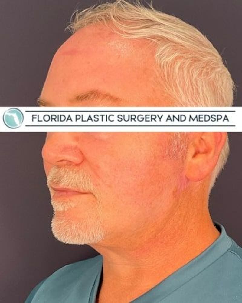 Dermal Fillers Before & After Gallery - Patient 386850 - Image 3