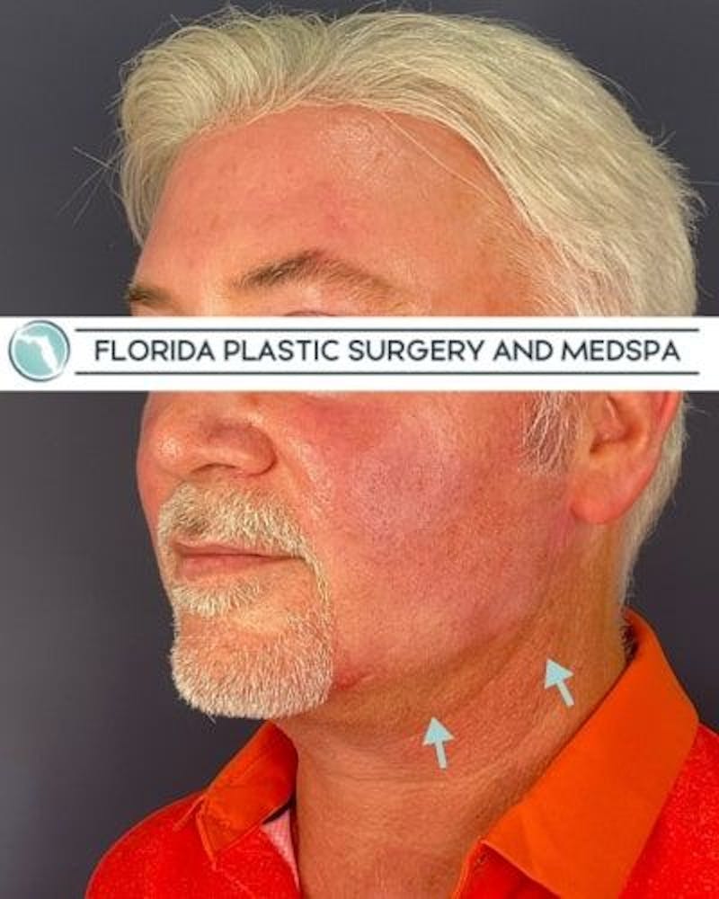 Dermal Fillers Before & After Gallery - Patient 386850 - Image 4