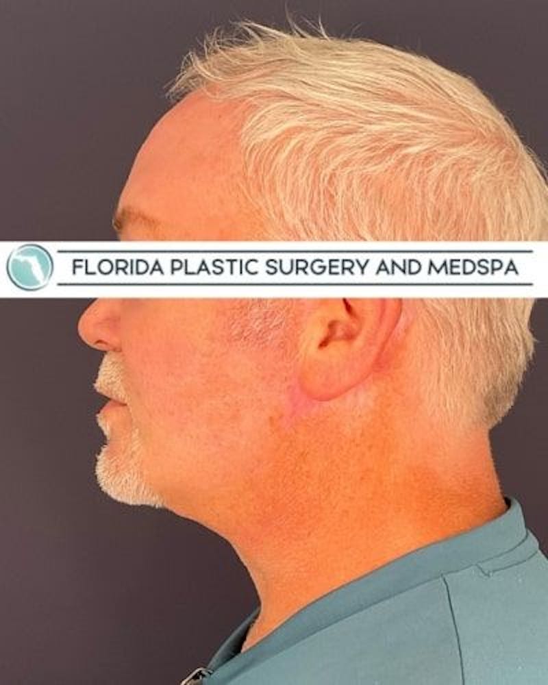 Dermal Fillers Before & After Gallery - Patient 386850 - Image 5