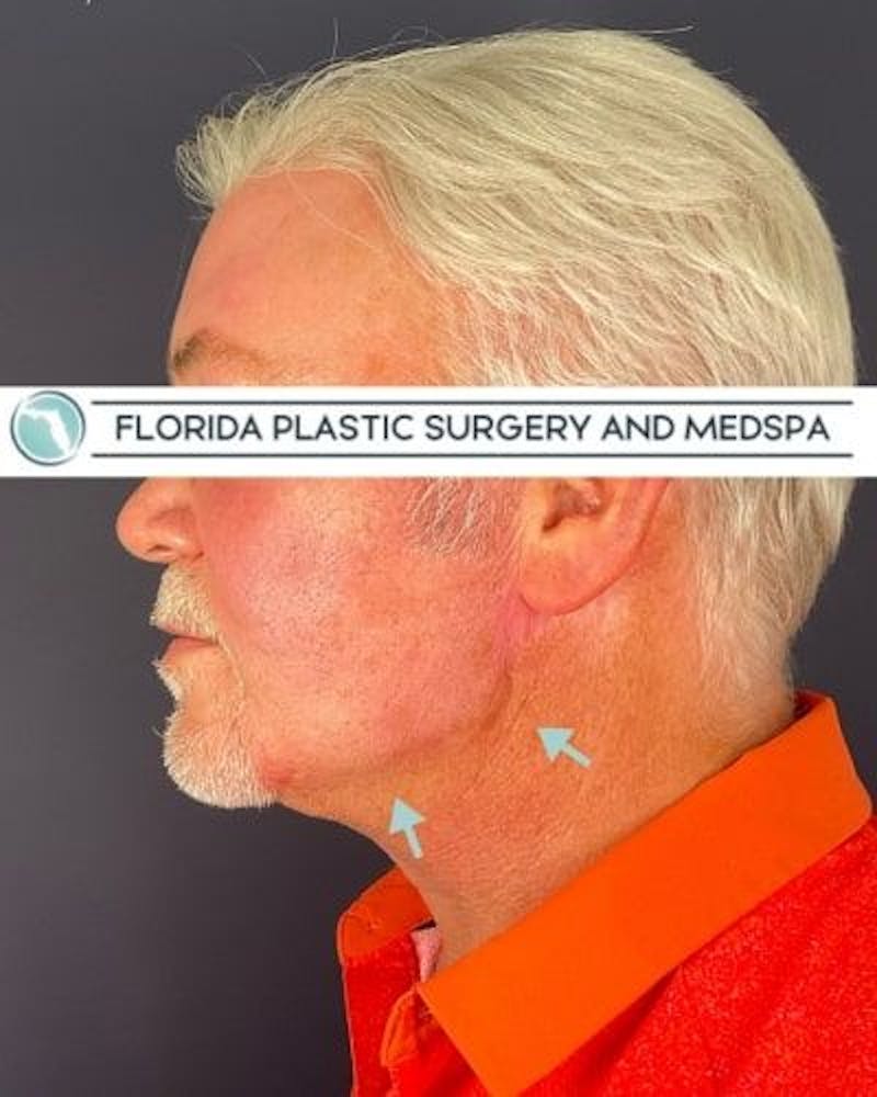 Dermal Fillers Before & After Gallery - Patient 386850 - Image 6