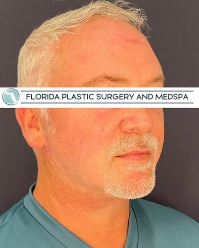 Dermal Fillers Before & After Gallery - Patient 386850 - Image 7