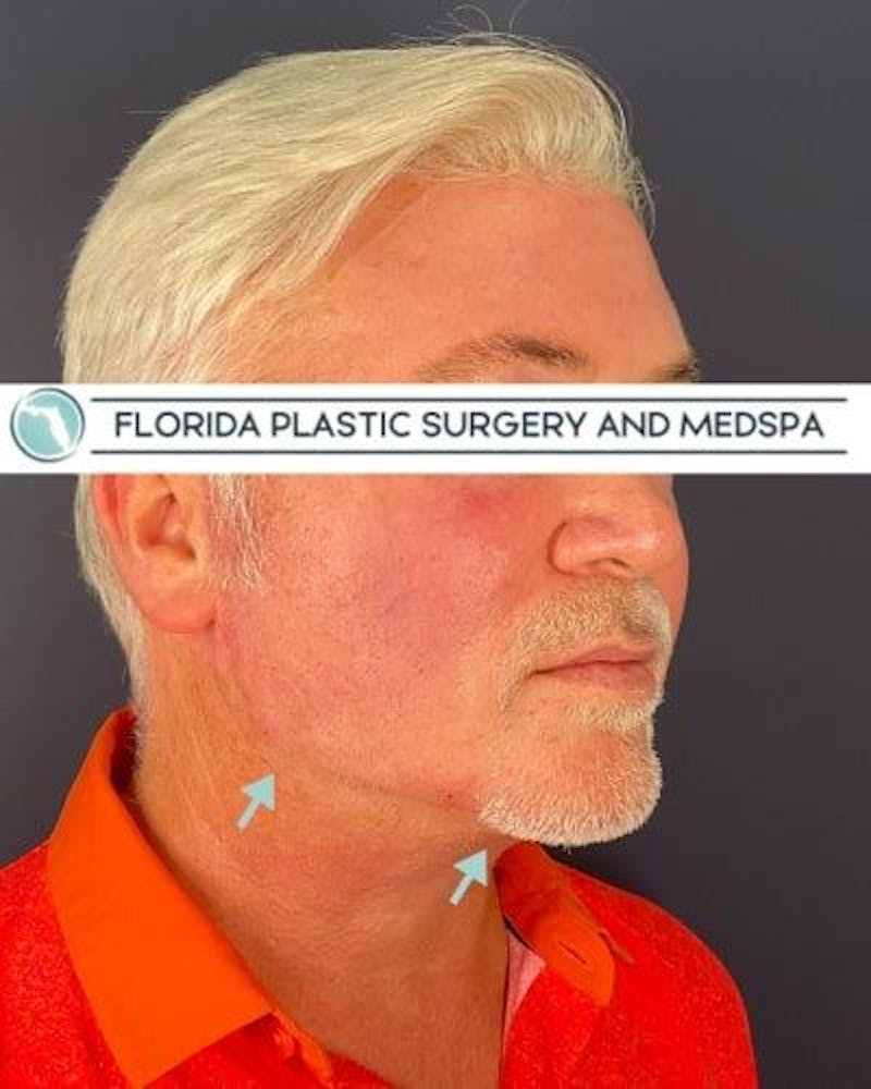 Dermal Fillers Before & After Gallery - Patient 386850 - Image 8