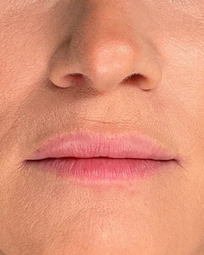 Dermal Fillers Before & After Gallery - Patient 424809 - Image 1