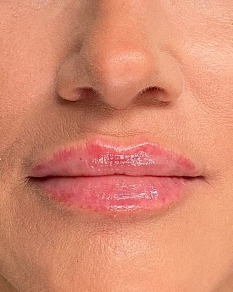 Dermal Fillers Before & After Gallery - Patient 424809 - Image 2