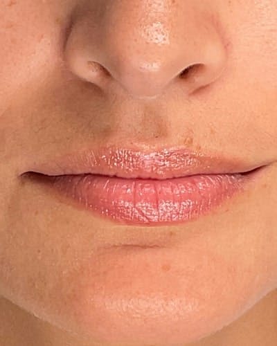 Dermal Fillers Before & After Gallery - Patient 361177 - Image 1