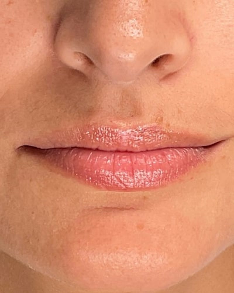 Dermal Fillers Before & After Gallery - Patient 361177 - Image 1