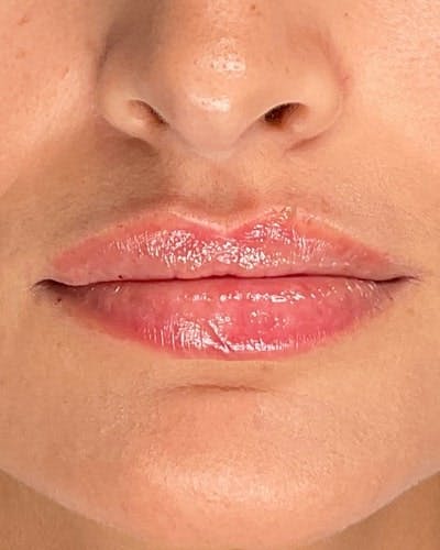 Dermal Fillers Before & After Gallery - Patient 361177 - Image 2