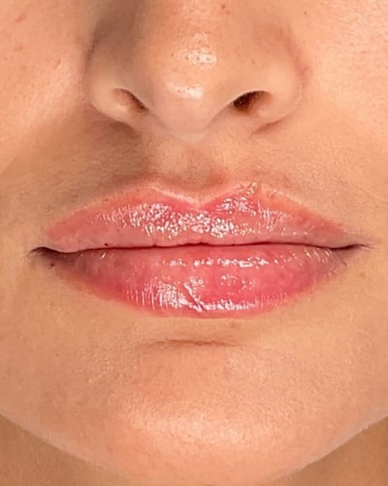 Dermal Fillers Before & After Gallery - Patient 361177 - Image 2