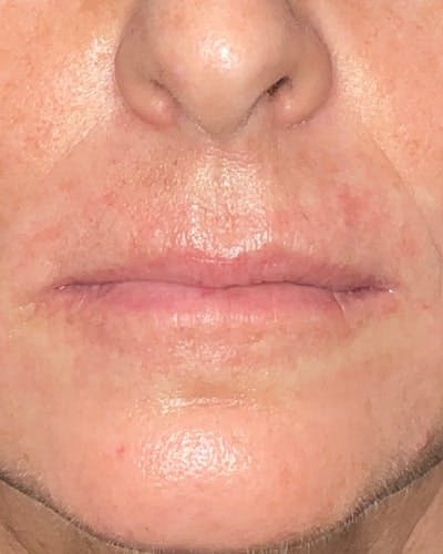 Dermal Fillers Before & After Gallery - Patient 369161 - Image 1