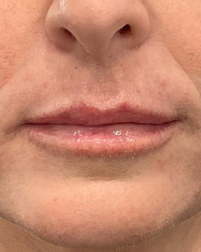 Dermal Fillers Before & After Gallery - Patient 369161 - Image 2
