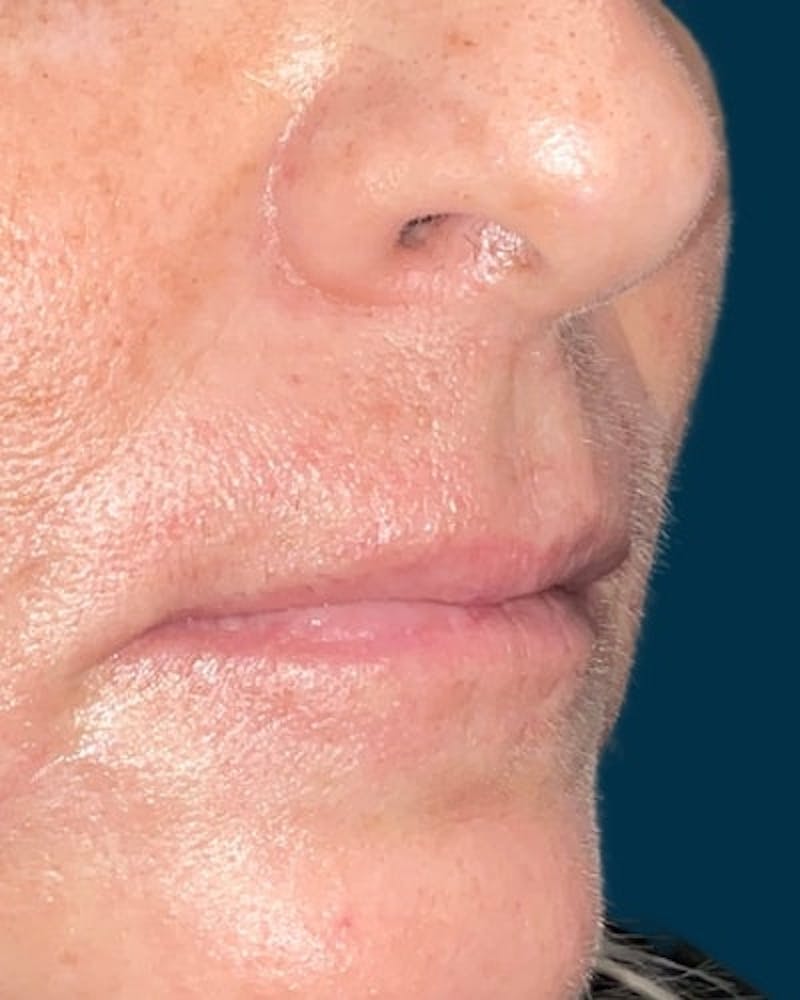 Dermal Fillers Before & After Gallery - Patient 369161 - Image 3