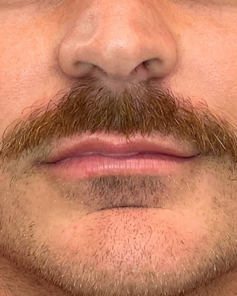 Dermal Fillers Before & After Gallery - Patient 268366 - Image 1