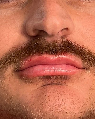 Dermal Fillers Before & After Gallery - Patient 268366 - Image 2
