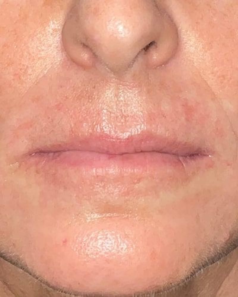 Dermal Fillers Before & After Gallery - Patient 180622 - Image 1