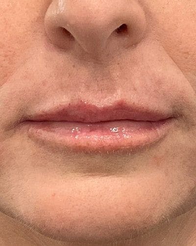 Dermal Fillers Before & After Gallery - Patient 180622 - Image 2