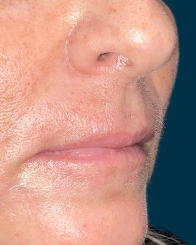 Dermal Fillers Before & After Gallery - Patient 180622 - Image 3