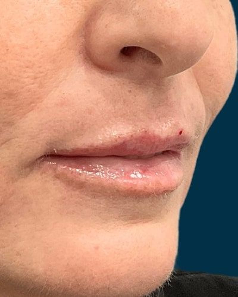 Dermal Fillers Before & After Gallery - Patient 180622 - Image 4