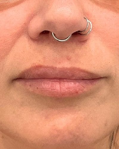 Dermal Fillers Before & After Gallery - Patient 320111 - Image 1