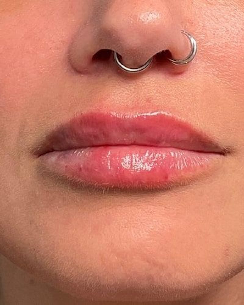Dermal Fillers Before & After Gallery - Patient 320111 - Image 2