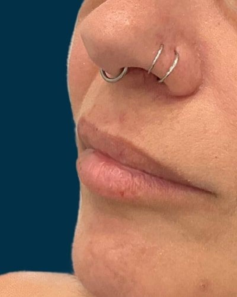 Dermal Fillers Before & After Gallery - Patient 320111 - Image 3