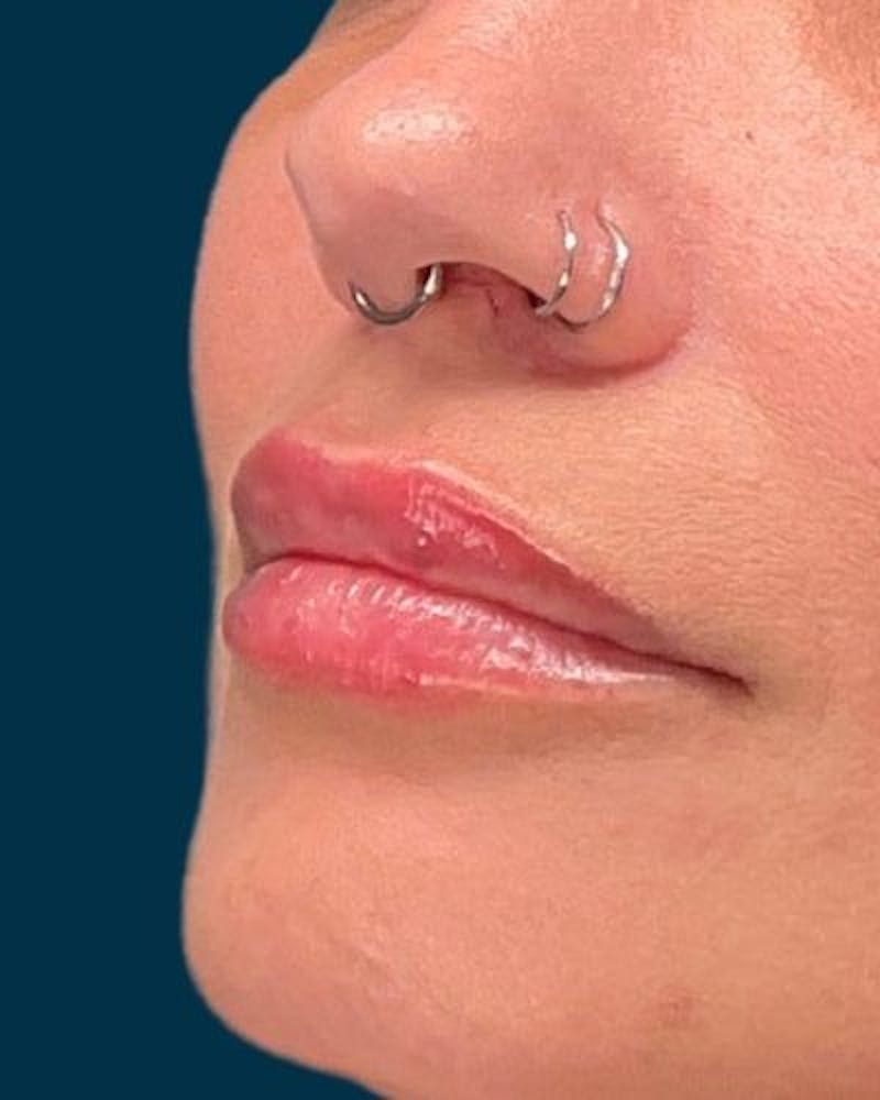 Dermal Fillers Before & After Gallery - Patient 320111 - Image 4