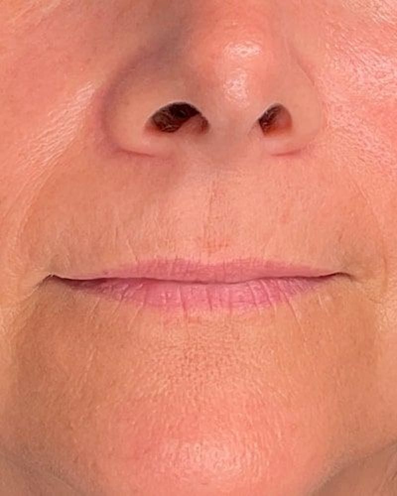Dermal Fillers Before & After Gallery - Patient 239171 - Image 1