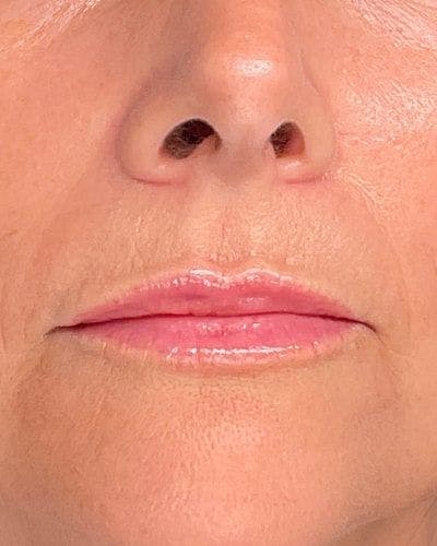 Dermal Fillers Before & After Gallery - Patient 239171 - Image 2