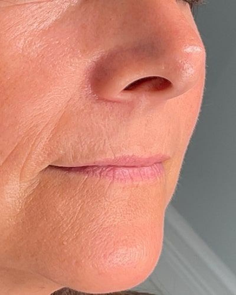 Dermal Fillers Before & After Gallery - Patient 239171 - Image 3