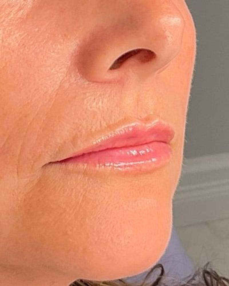 Dermal Fillers Before & After Gallery - Patient 239171 - Image 4