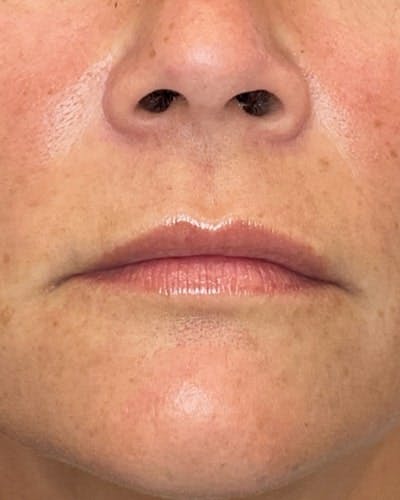 Dermal Fillers Before & After Gallery - Patient 363400 - Image 1