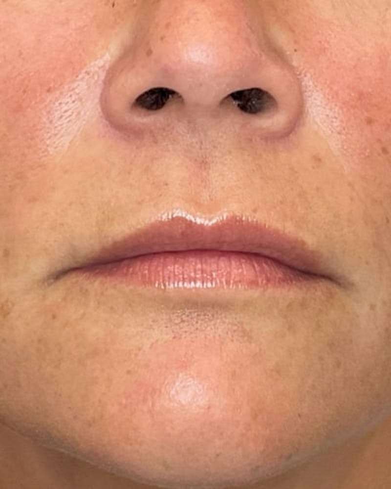 Dermal Fillers Before & After Gallery - Patient 363400 - Image 1