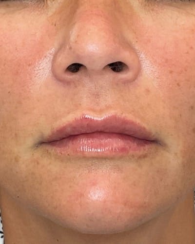 Dermal Fillers Before & After Gallery - Patient 363400 - Image 2
