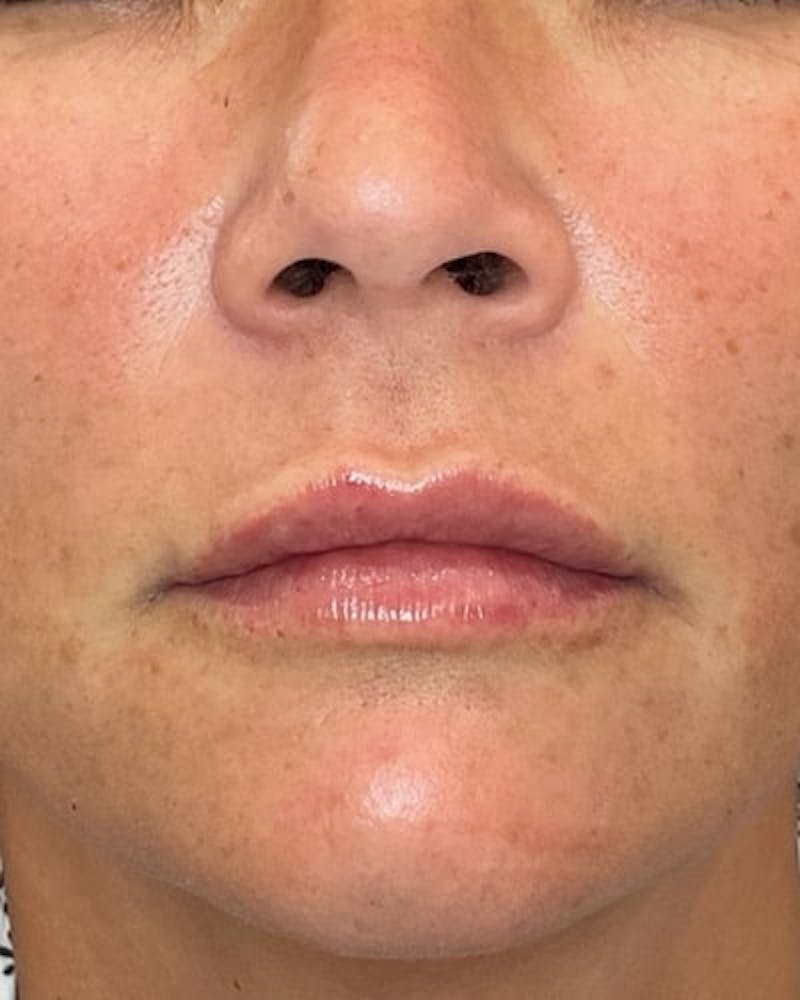 Dermal Fillers Before & After Gallery - Patient 363400 - Image 2