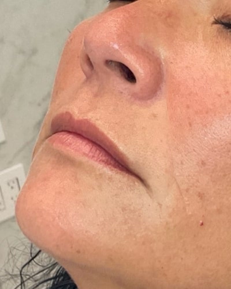 Dermal Fillers Before & After Gallery - Patient 363400 - Image 3