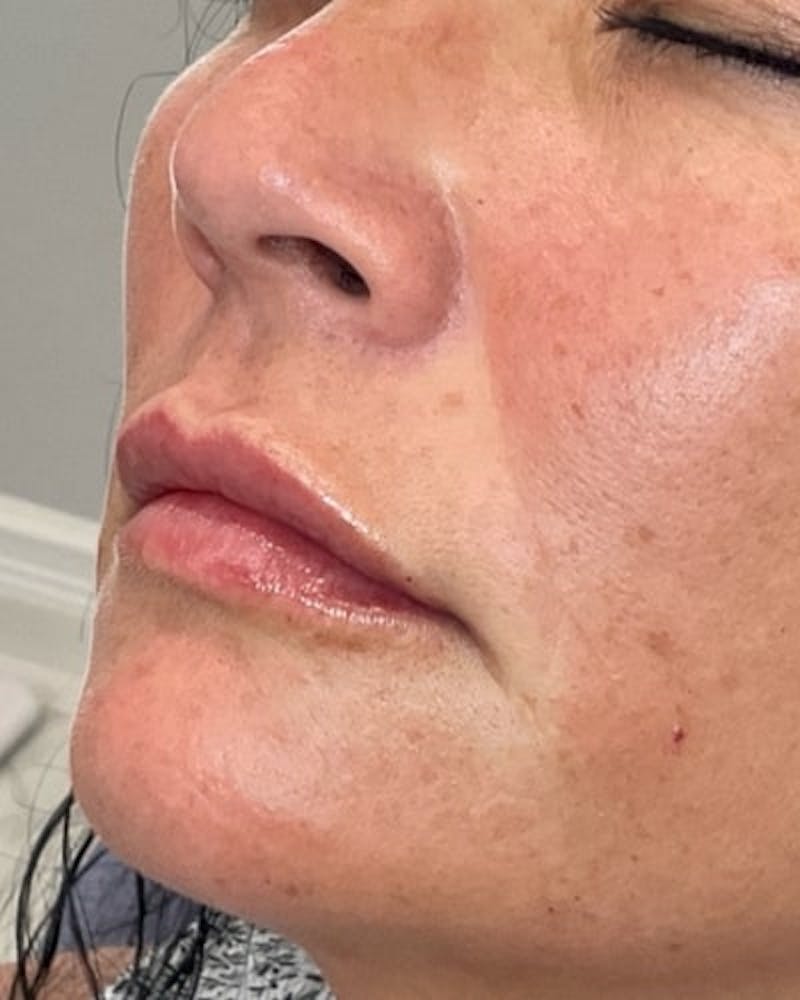 Dermal Fillers Before & After Gallery - Patient 363400 - Image 4