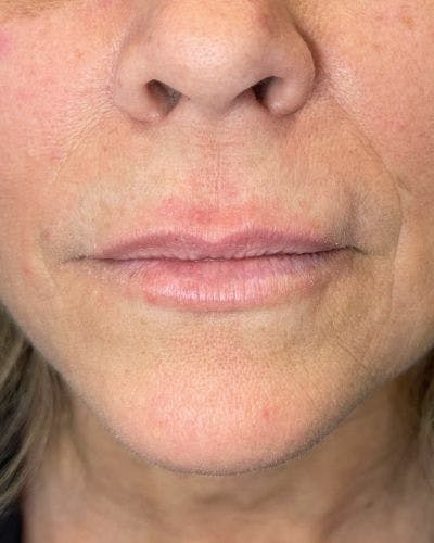 Dermal Fillers Before & After Gallery - Patient 989554 - Image 1