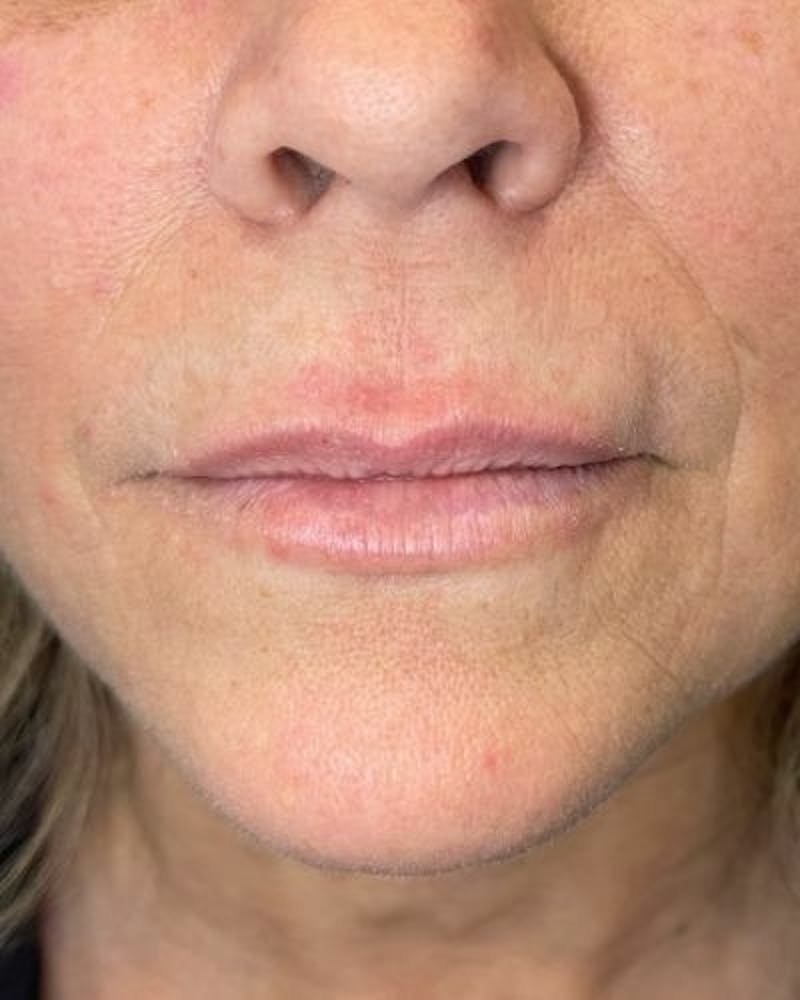 Dermal Fillers Before & After Gallery - Patient 989554 - Image 1
