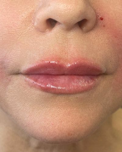 Dermal Fillers Before & After Gallery - Patient 989554 - Image 2