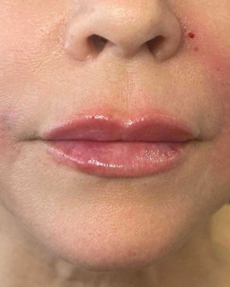Dermal Fillers Before & After Gallery - Patient 989554 - Image 2