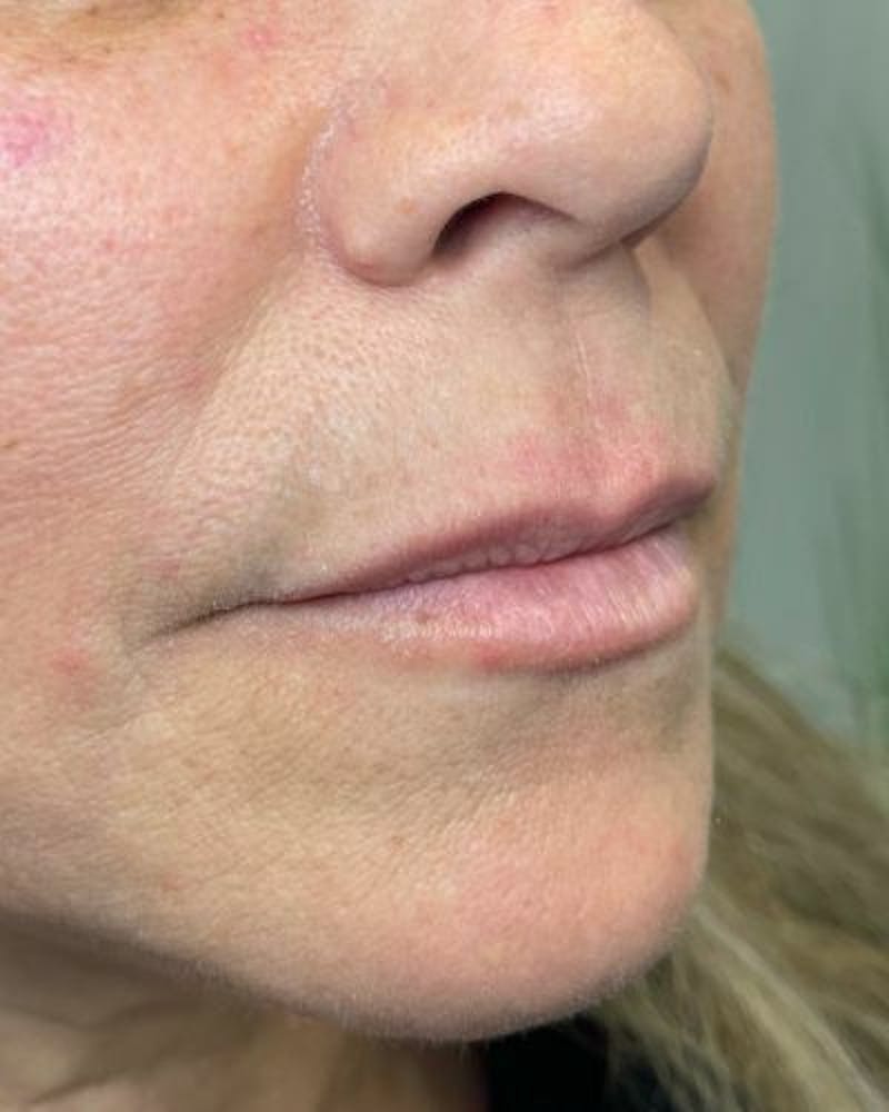 Dermal Fillers Before & After Gallery - Patient 989554 - Image 3