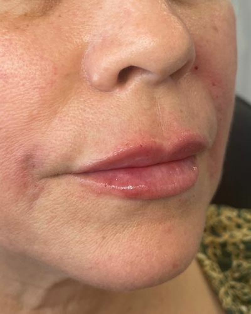 Dermal Fillers Before & After Gallery - Patient 989554 - Image 4