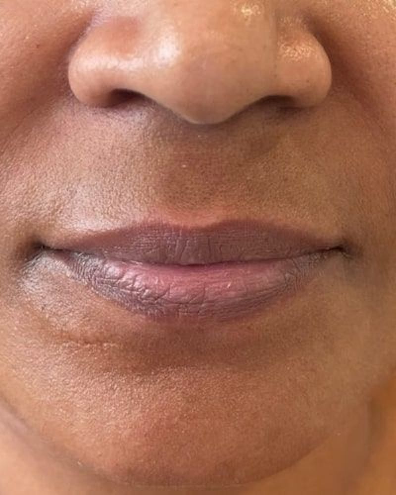 Dermal Fillers Before & After Gallery - Patient 594373 - Image 1