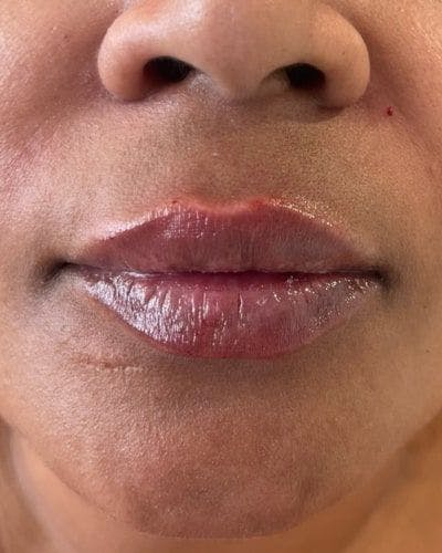Dermal Fillers Before & After Gallery - Patient 594373 - Image 2
