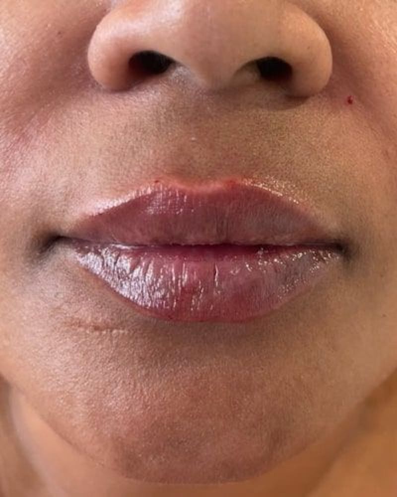 Dermal Fillers Before & After Gallery - Patient 594373 - Image 2