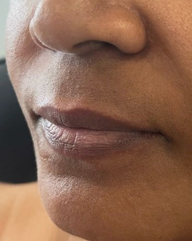 Dermal Fillers Before & After Gallery - Patient 594373 - Image 3