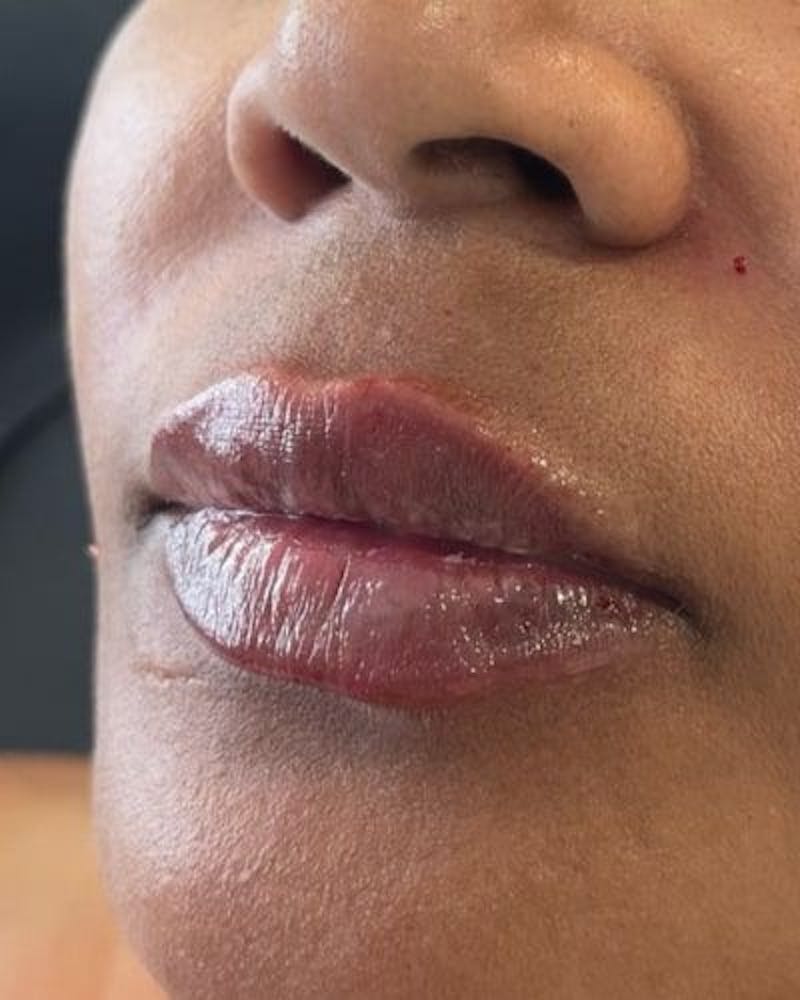 Dermal Fillers Before & After Gallery - Patient 594373 - Image 4