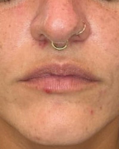 Dermal Fillers Before & After Gallery - Patient 344097 - Image 1